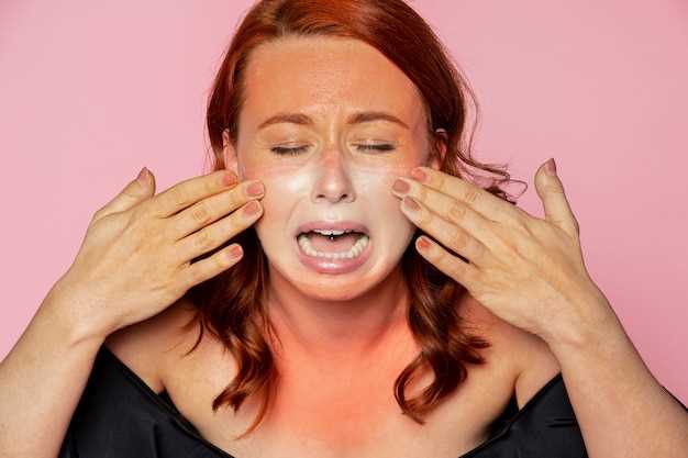 Причины и симптомы розацеа на лице