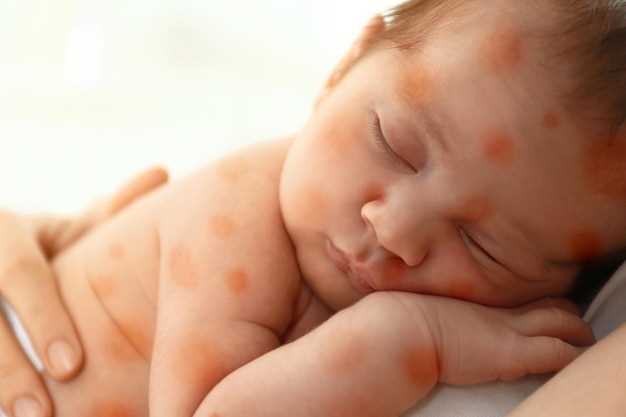 Дерматит у новорожденных: симптомы и проявления